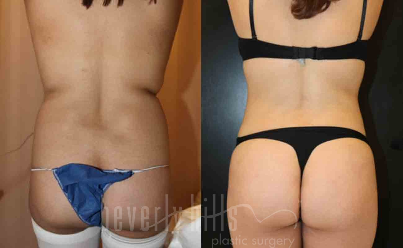 Liposuction Patient 22 Before & After
