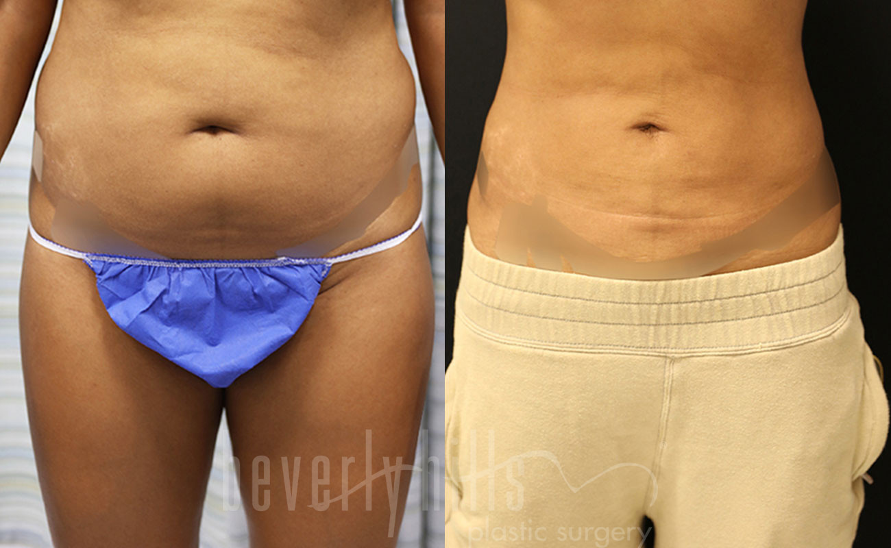 Liposuction Patient 53 Before & After