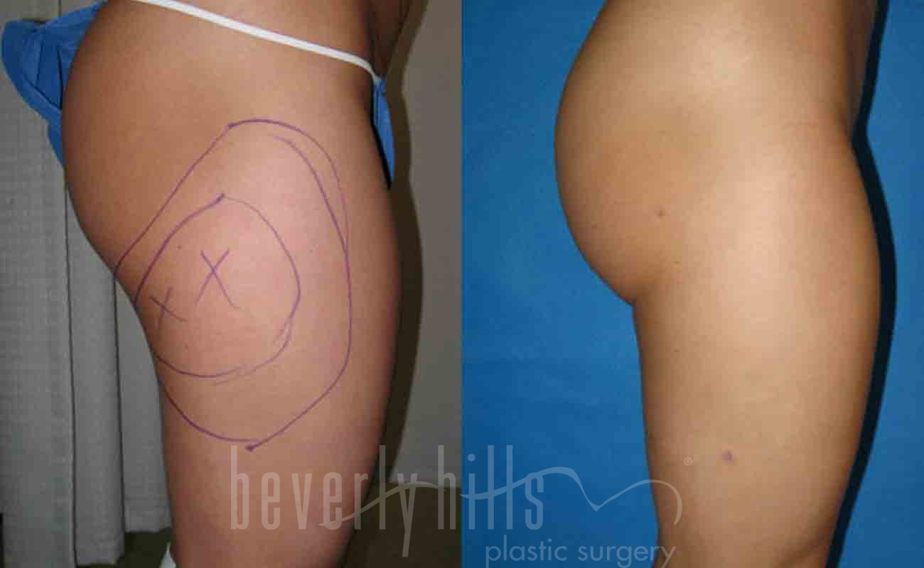 Liposuction Patient 23 Before & After