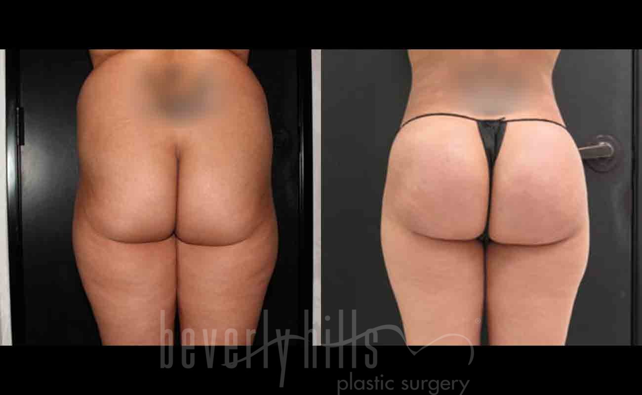 Liposuction Patient 24 Before & After