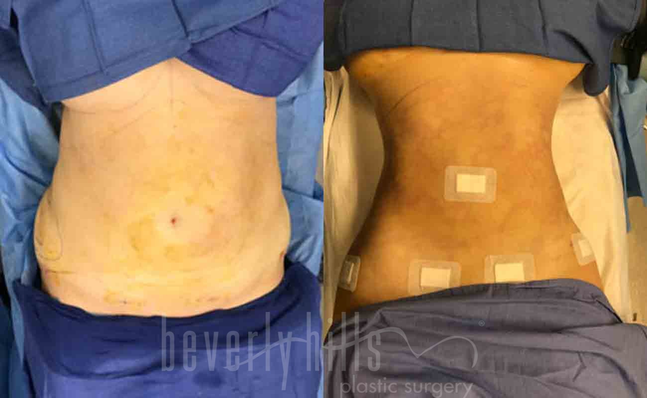 Liposuction Patient 25 Before & After