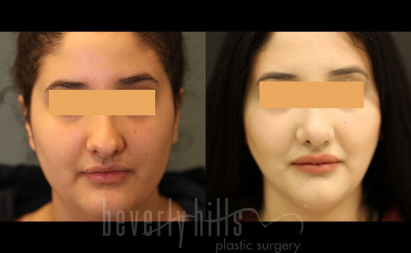 Liposuction Patient 46 Before & After