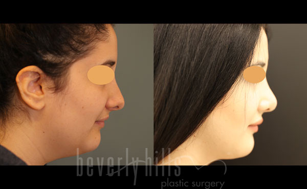 Liposuction Patient 46 Before & After