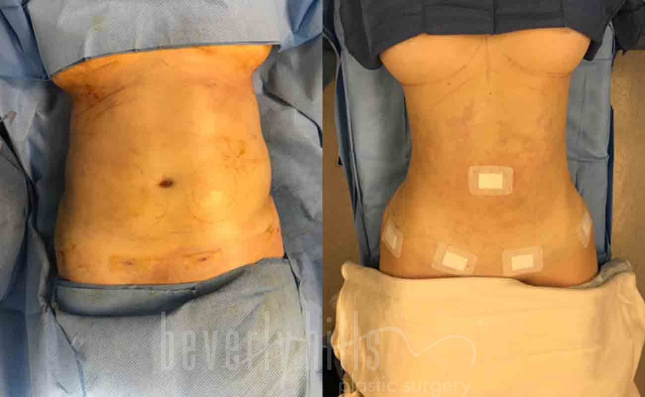 Liposuction Patient 26 Before & After