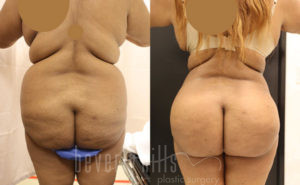 Liposuction Patient 45 Before & After - Thumbnail