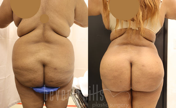 Liposuction Patient 45 Before & After