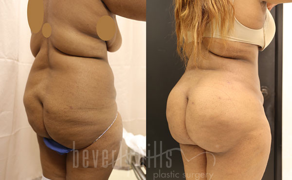 Liposuction Patient 45 Before & After