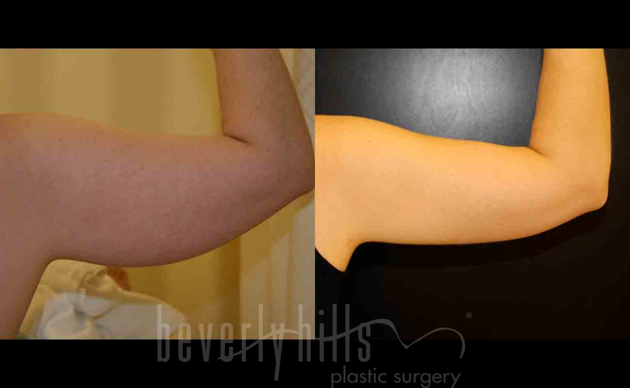 Liposuction Patient 27 Before & After