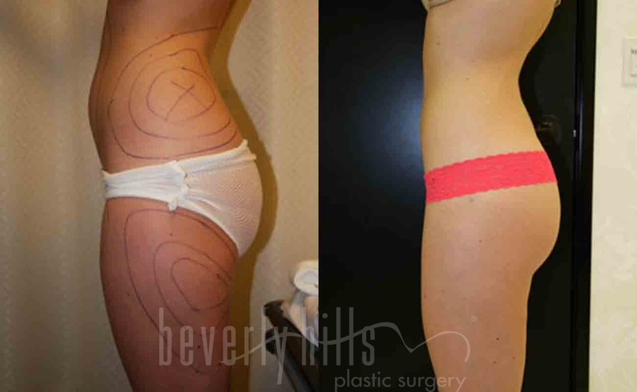 Liposuction Patient 28 Before & After