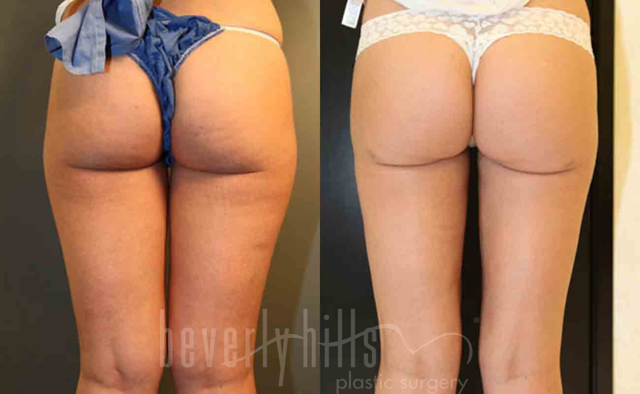 Liposuction Patient 29 Before & After