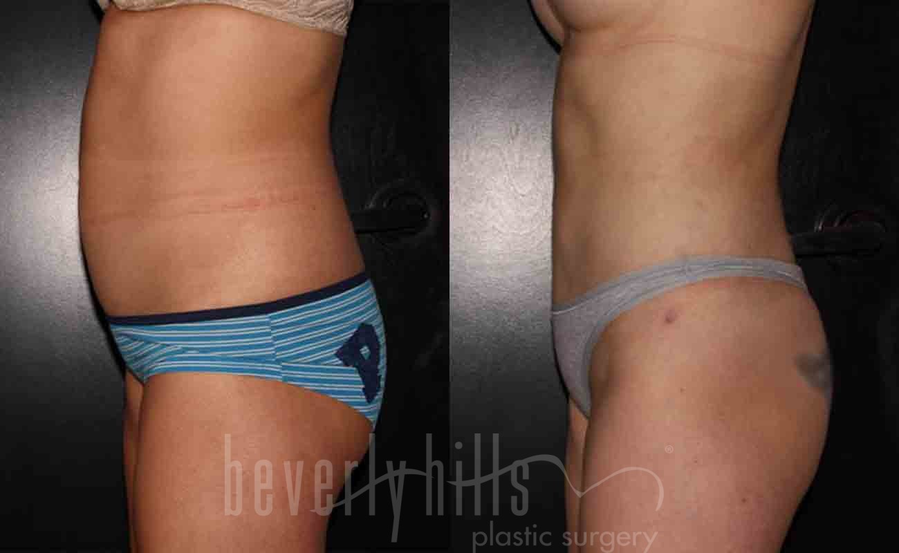 Liposuction Patient 30 Before & After