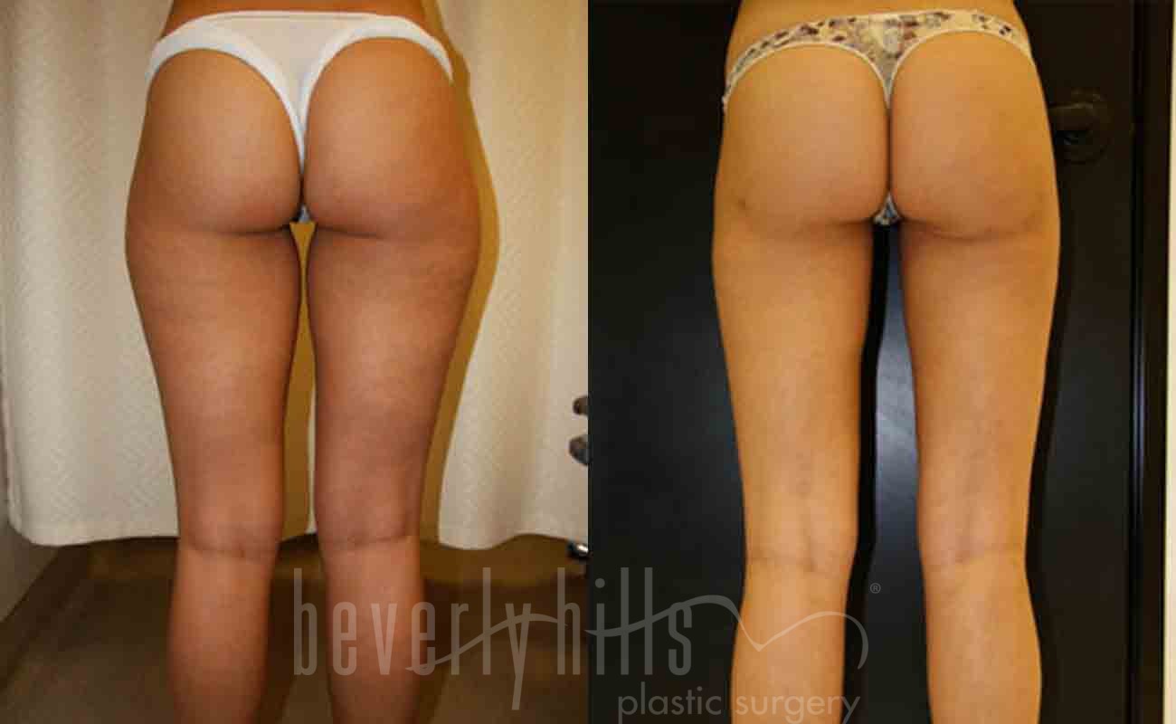 Liposuction Patient 31 Before & After