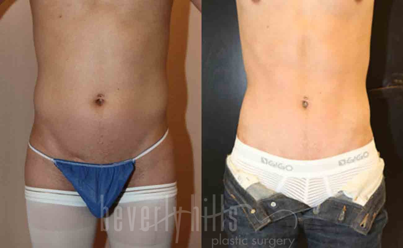 Abdominal Etching/Male Liposuction Patient 01 Before & After