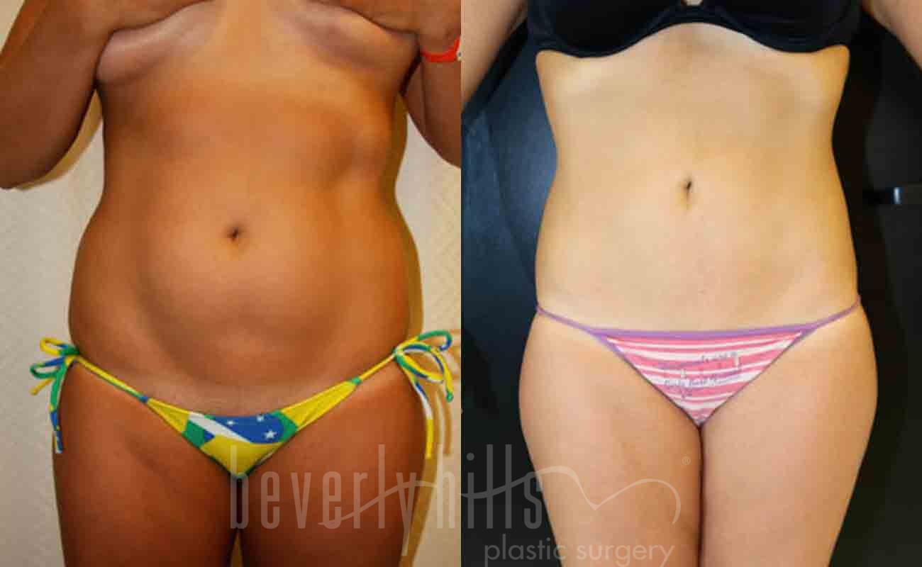 Liposuction Patient 33 Before & After