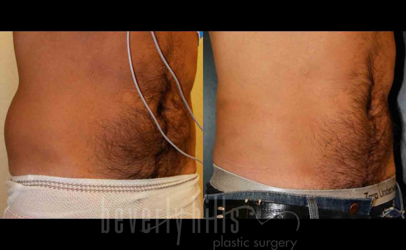 Abdominal Etching/Male Liposuction Patient 02 Before & After