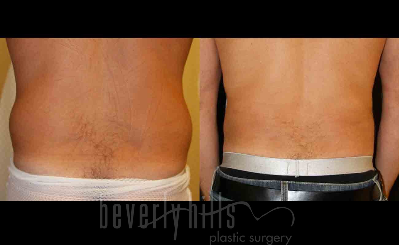 Abdominal Etching/Male Liposuction Patient 02 Before & After