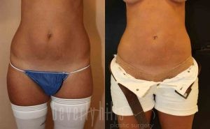 Liposuction Patient 35 Before & After - Thumbnail