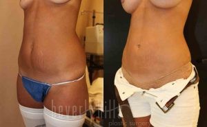 Liposuction Patient 35 Before & After - Thumbnail