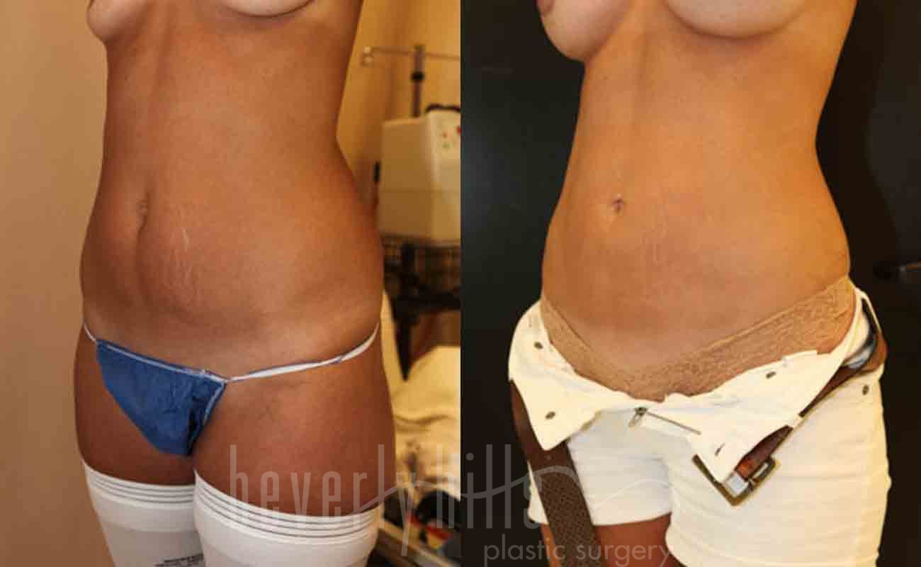 Liposuction Patient 35 Before & After