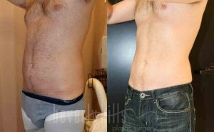 Abdominal Etching/Male Liposuction Patient 03 Before & After - Thumbnail