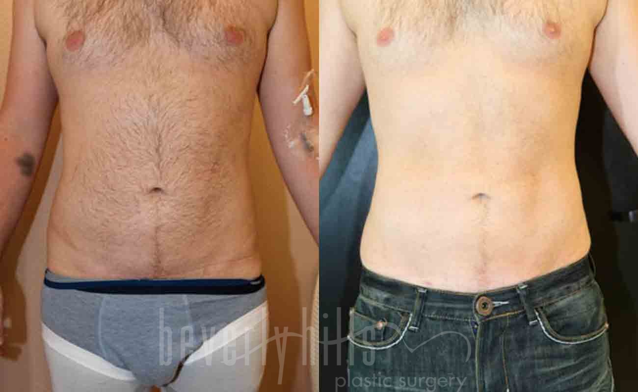 Abdominal Etching/Male Liposuction Patient 03 Before & After