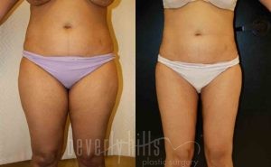 Liposuction Patient 37 Before & After - Thumbnail