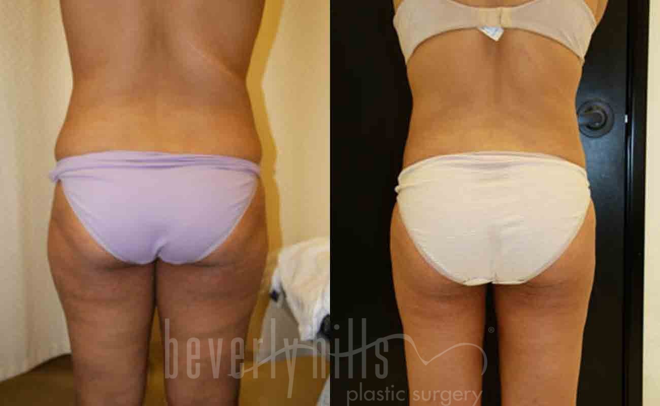 Liposuction Patient 37 Before & After