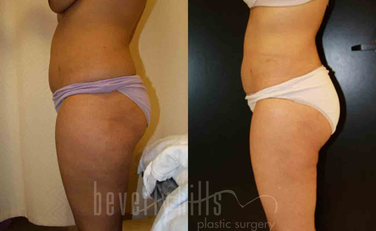 Liposuction Patient 37 Before & After