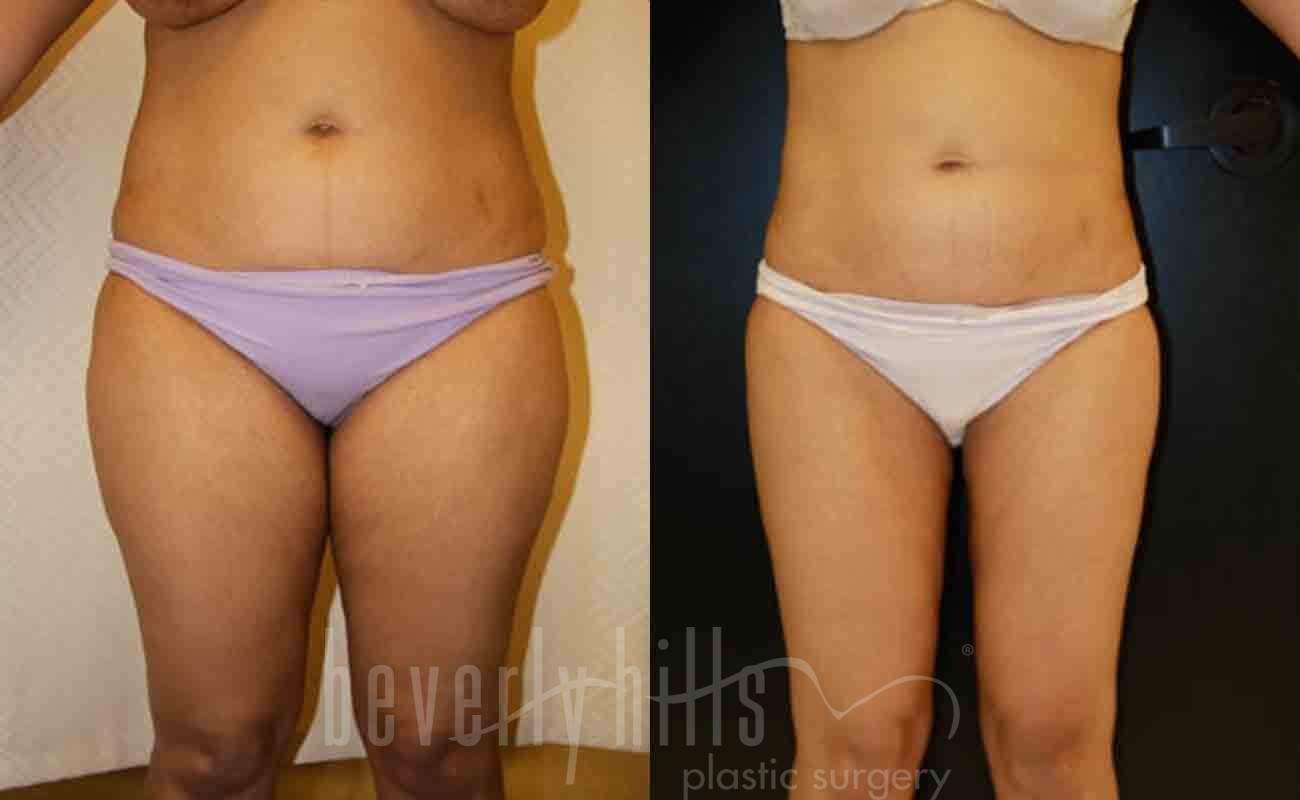 Liposuction Patient 37 Before & After