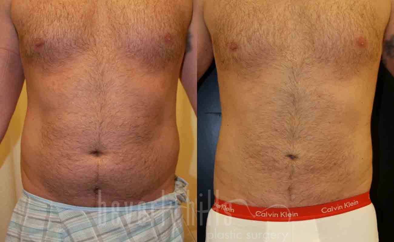 Abdominal Etching/Male Liposuction Patient 04 Before & After