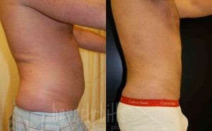 Abdominal Etching/Male Liposuction Patient 04 Before & After - Thumbnail