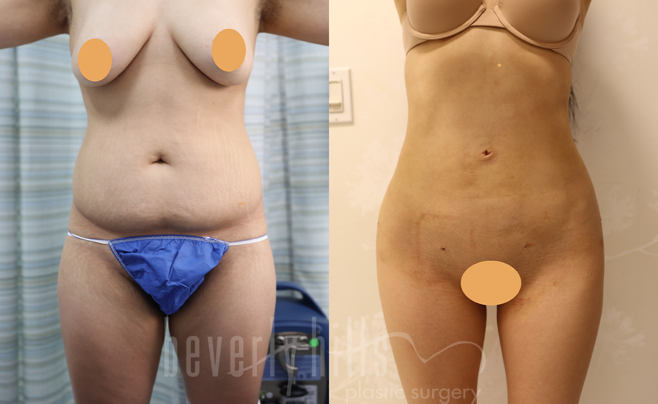 Liposuction Patient 47 Before & After