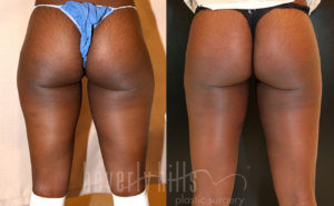 Liposuction Patient 57 Before & After - Thumbnail