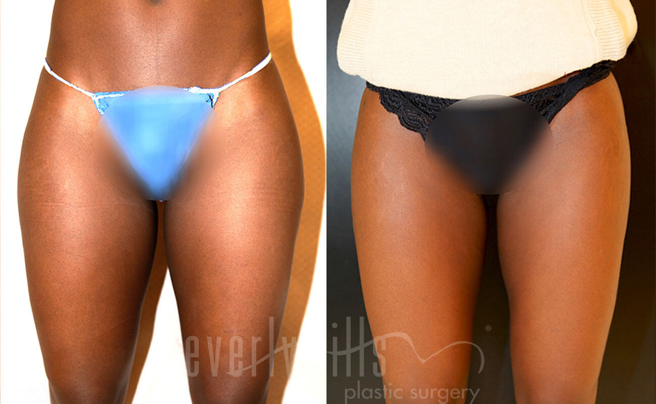 Liposuction Patient 57 Before & After