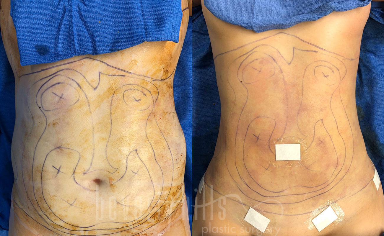 Liposuction Patient 40 Before & After