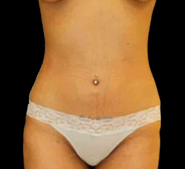 Case--1380 | After Mommy Makeover