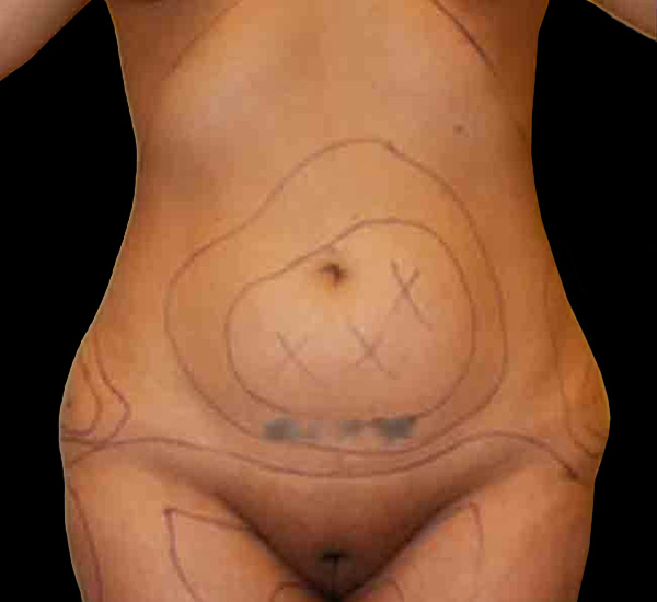 Case--1380 | Before Mommy Makeover