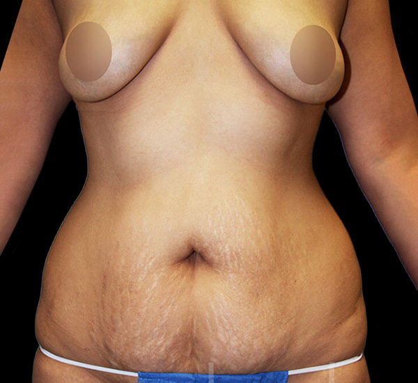 Mommy Makeover Patient Before - 2