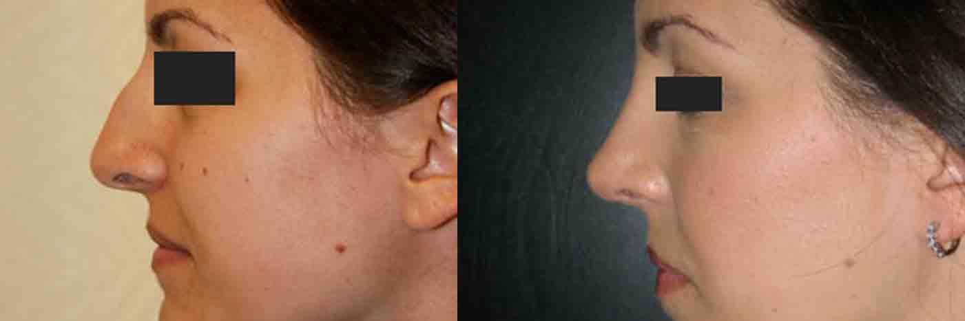 Rhinoplasty Patient 04 Before & After