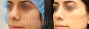 Rhinoplasty Patient 25 Before & After - Thumbnail