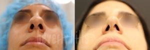 Rhinoplasty Patient 25 Before & After - Thumbnail