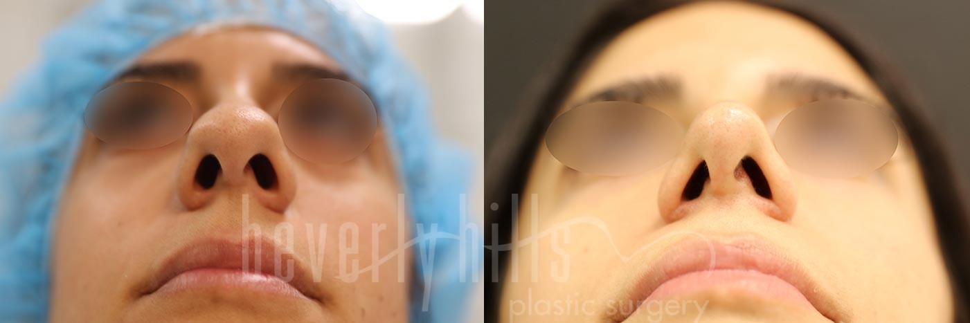 Rhinoplasty Patient 25 Before & After