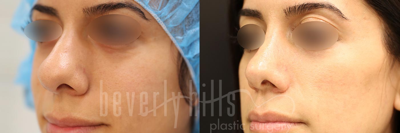 Rhinoplasty Patient 25 Before & After