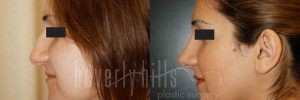 Rhinoplasty Patient 01 Before & After - Thumbnail