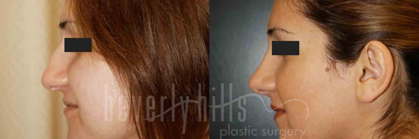 Rhinoplasty Patient 01 Before & After