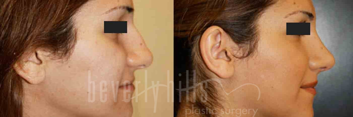 Rhinoplasty Patient 01 Before & After