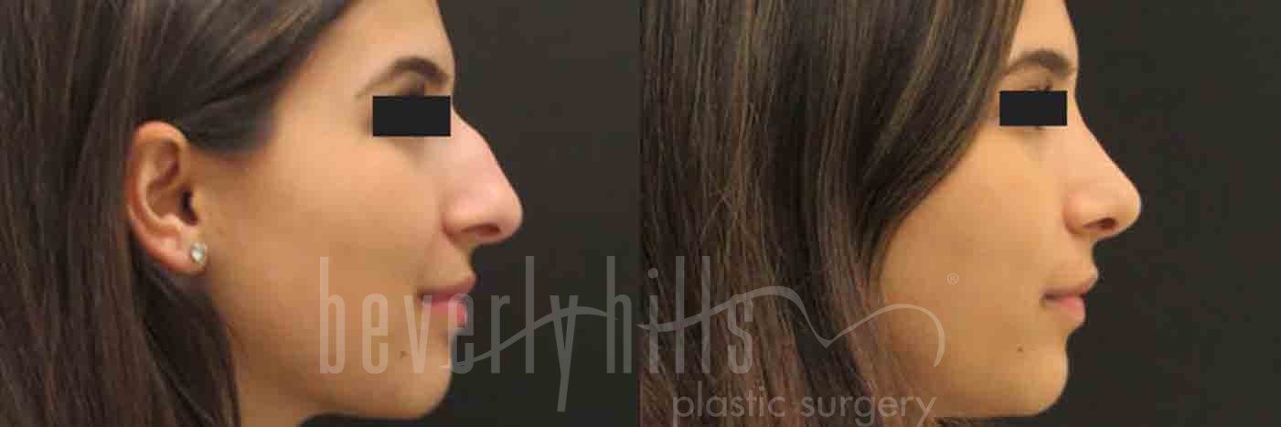 Rhinoplasty Patient 02 Before & After