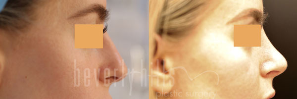 Rhinoplasty Patient 22 Before & After