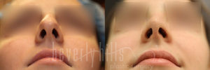 Rhinoplasty 30 Before & After - Thumbnail