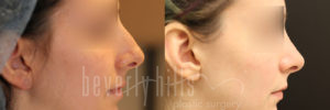 Rhinoplasty 30 Before & After - Thumbnail